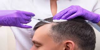 PRP Technique for Hair