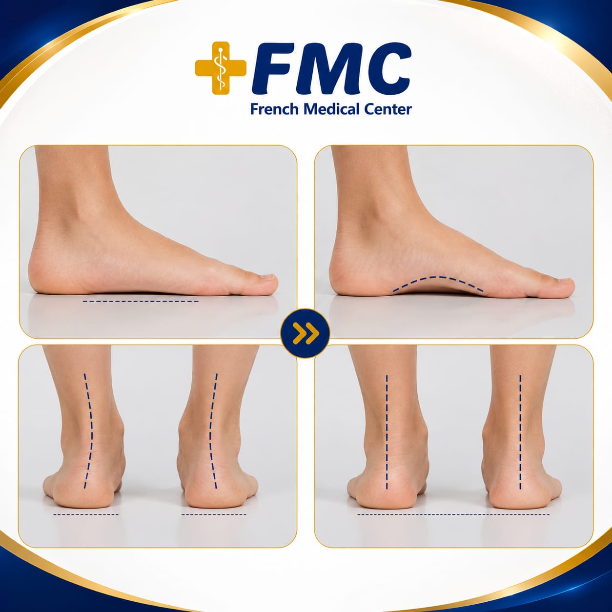 The importance of physical therapy for flat feet