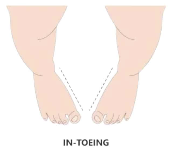 Intoeing