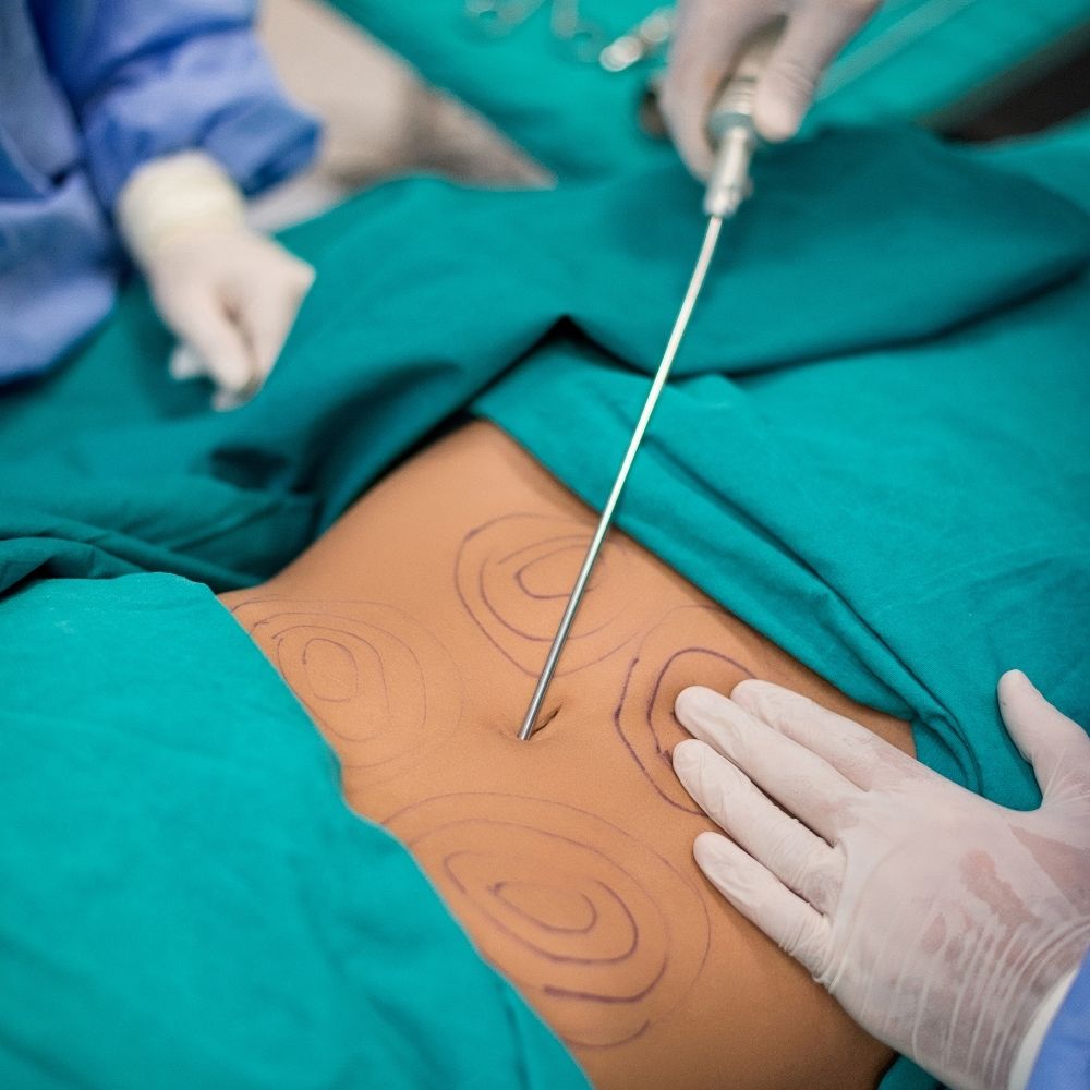 Liposuction
