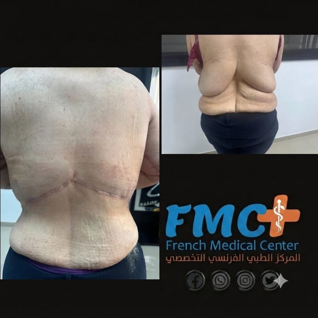 Back lift and sculpting (torso aesthetics)