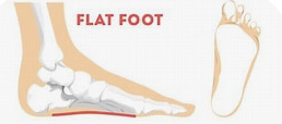 Flat feet