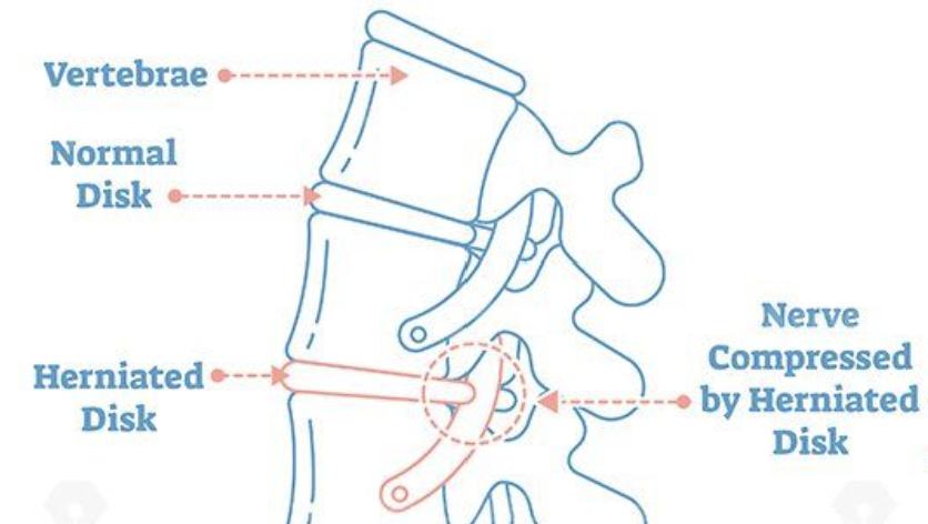 10 Natural Sciatic Nerve Pain Relief Options (Chiropractic Approach)