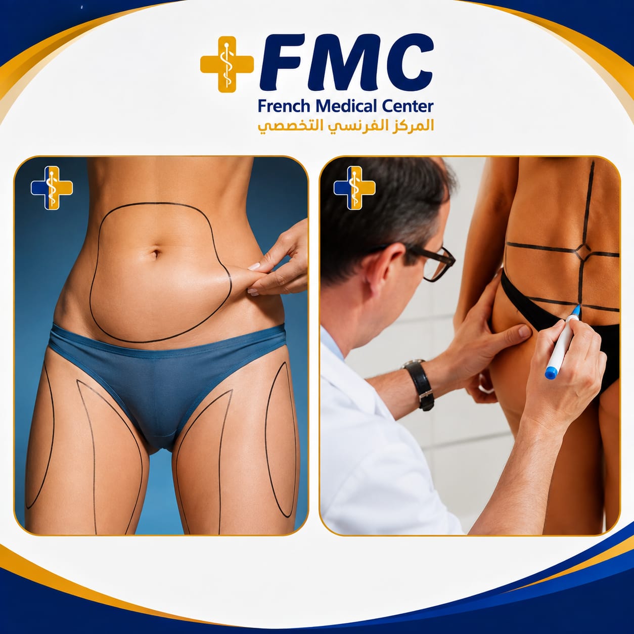 Getting rid of belly fat through surgery